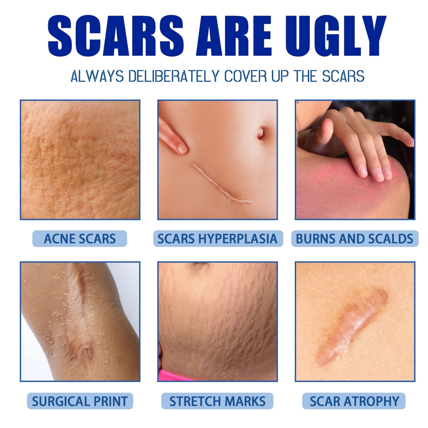 SCAR REMOVAL CREAM - Helps reduce scars and acne marks